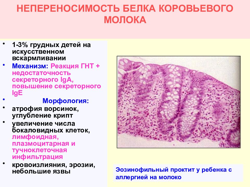 Симптомы аллергии на коровье молоко у грудничка. Непереносимость белков коровьего молока. Непереносимость белка коровьего молока симптомы. Непереносимость белка. Признаки непереносимости белка коровьего молока.