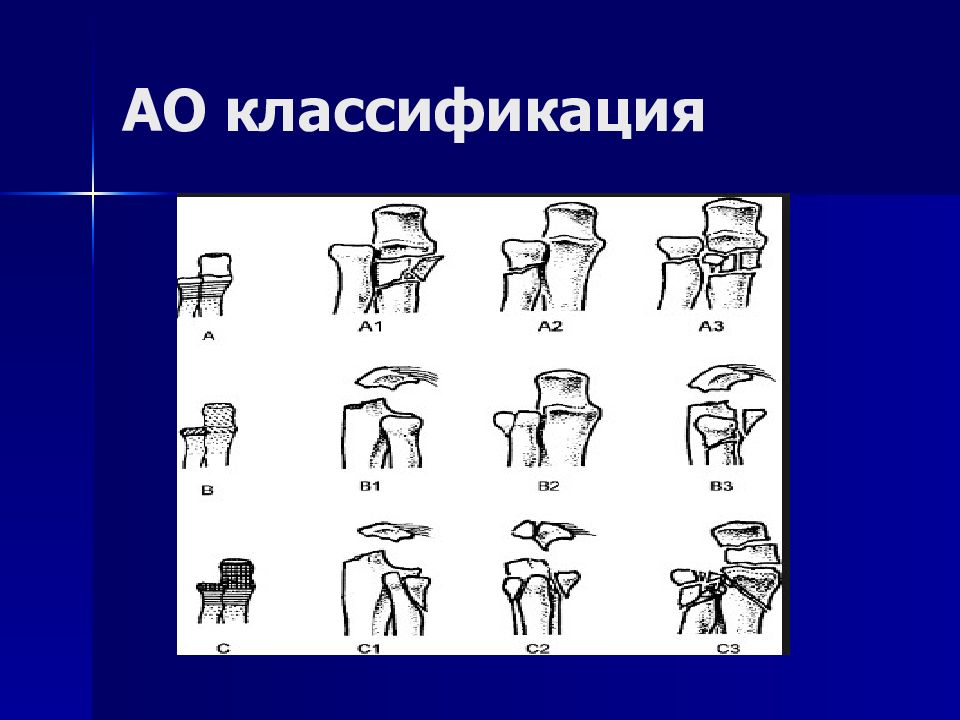 Классификация верхних конечностей. АО классификация верхней конечности. Ao classification