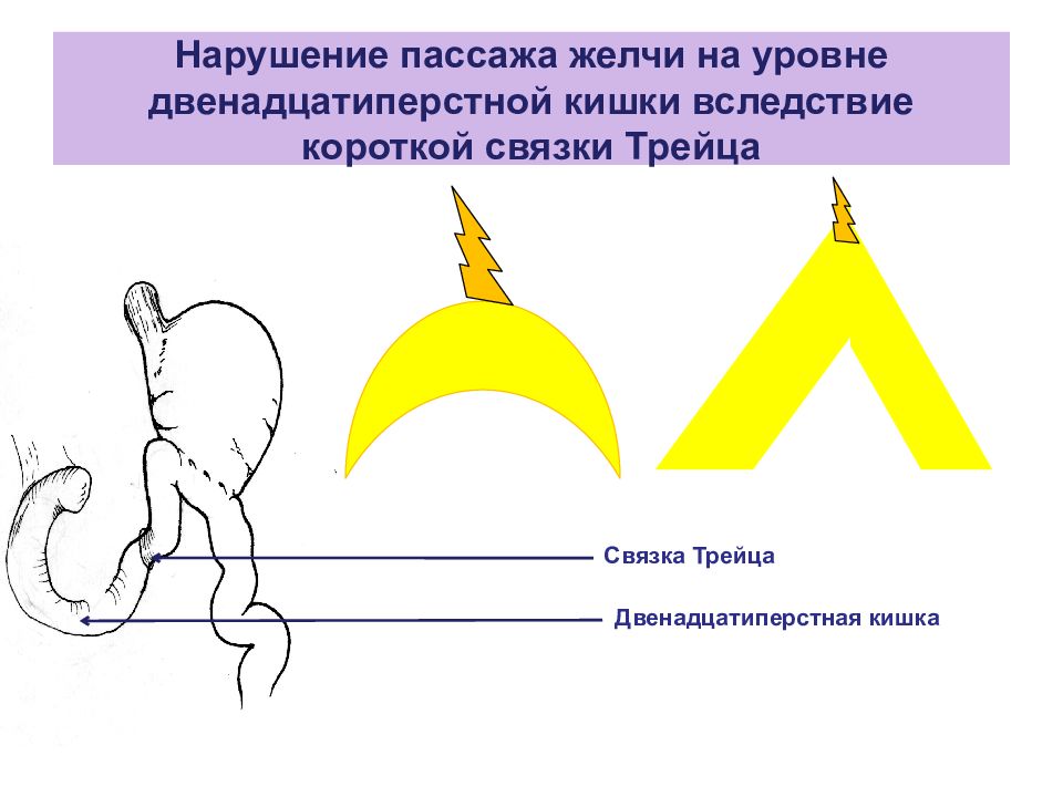 Пассаж желчи не определяется. Что означает Пассаж желчи нарушен.