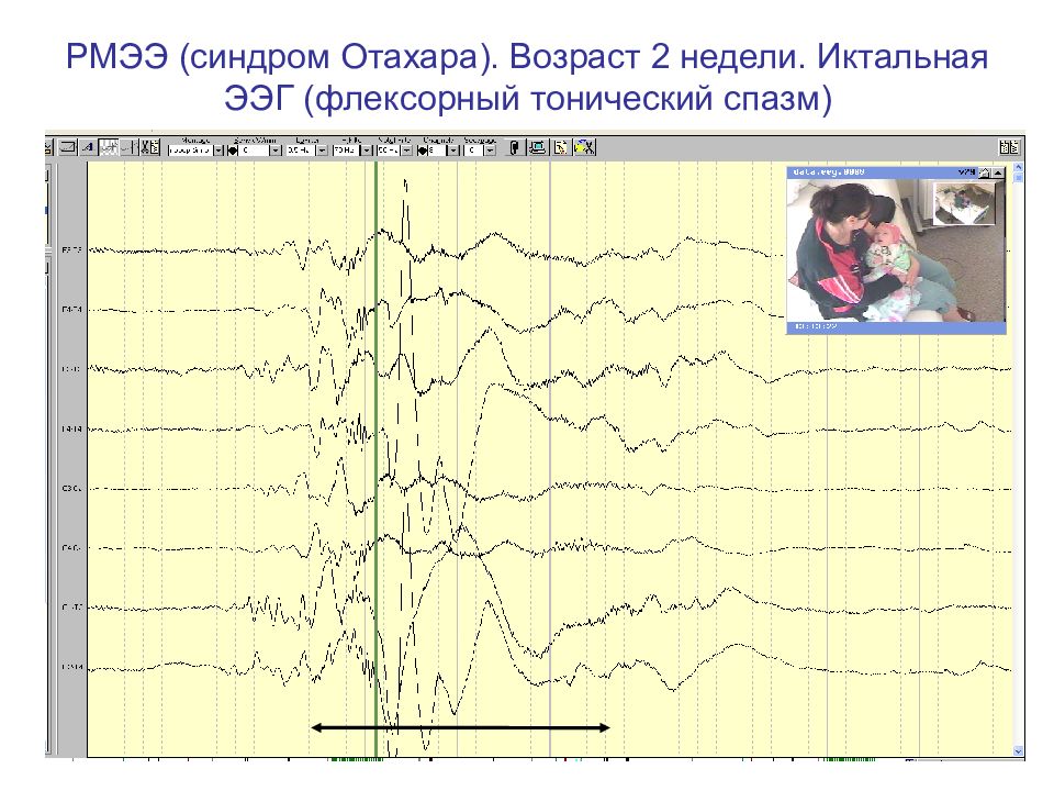 Лобная эпилепсия. Синдром Отахара. Синдром Отахара лечение.