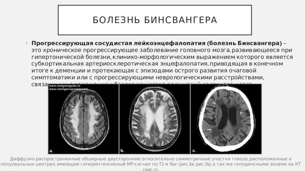 Вич энцефалопатия. Лейкоэнцефалопатия головного мозга сосудистого генеза. Болезнью Бинсвангера это энцефалопатия. Болезнь Бинсвангера прогрессирующая лейкоэнцефалопатия. Мрт головного мозга при лейкоэнцефалопатии.