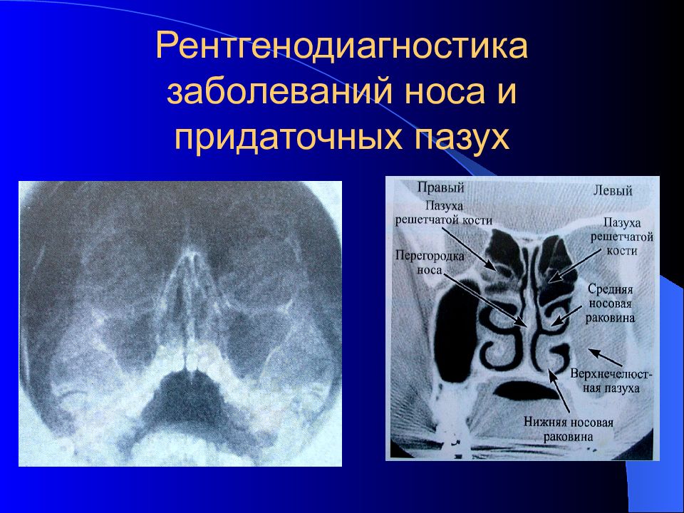 Причины заболевания носа. Кт снимок пазух носа. Рентгенодиагностика заболеваний носа. Болезни носа и придаточных пазух. Рентгенодиагностика заболеваний придаточных пазух носа.