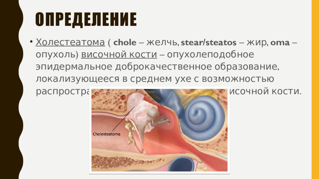 Холеастома. Холестеатома среднего уха гистология. Средний отит с холестеатома. Опухоль уха холестеатома. Холестеатома отоскопия.