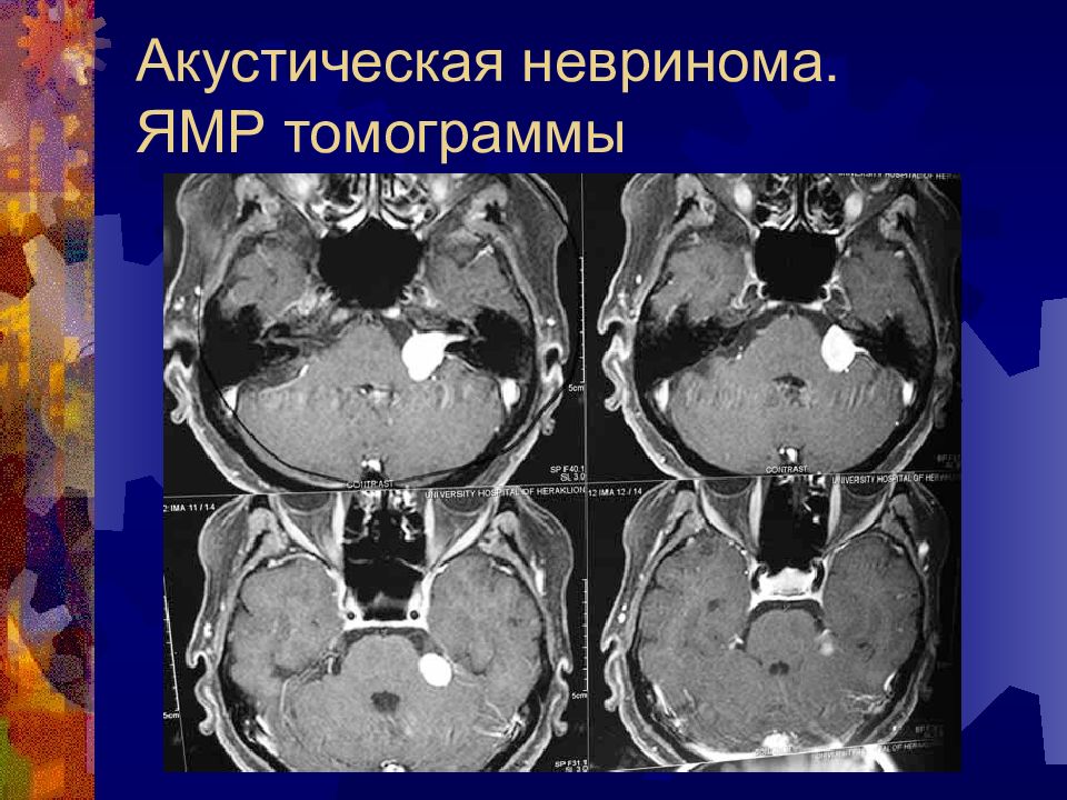 Невринома. Шваннома средостения кт. Акустическая невринома. Невринома слухового нерва рентген.