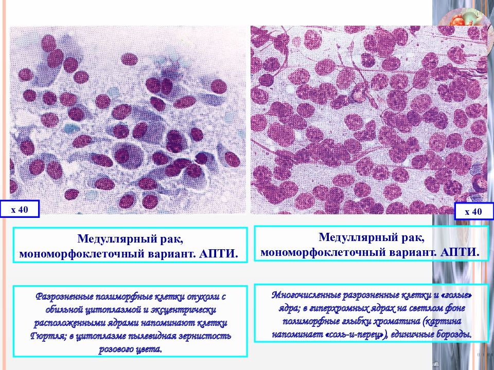 Медуллярный рак рекомендации. Медуллярная карцинома щитовидной железы. Гистологическая классификация опухолей щитовидной железы. Клетки Гюртля в щитовидной железе это.