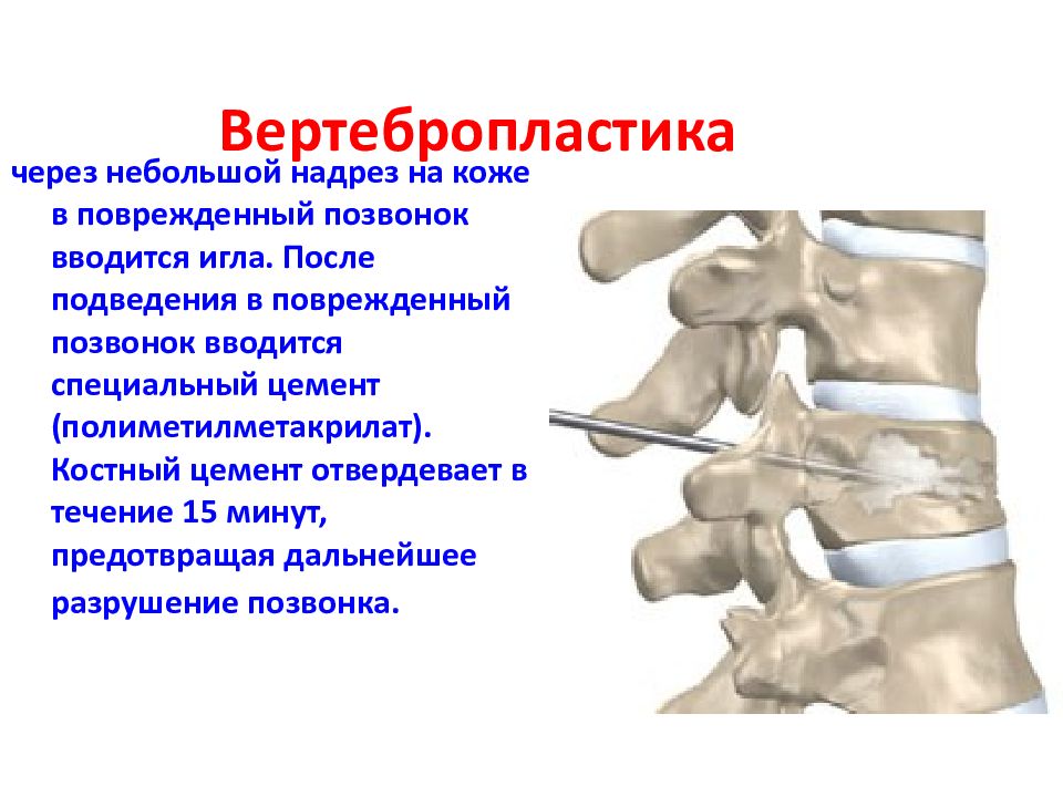 Операция позвонков. Вертебропластика при переломе позвоночника. Цементирование гемангиомы позвоночника. Вертебропластика l2 позвонка. Гемангиома позвонка цементирование.