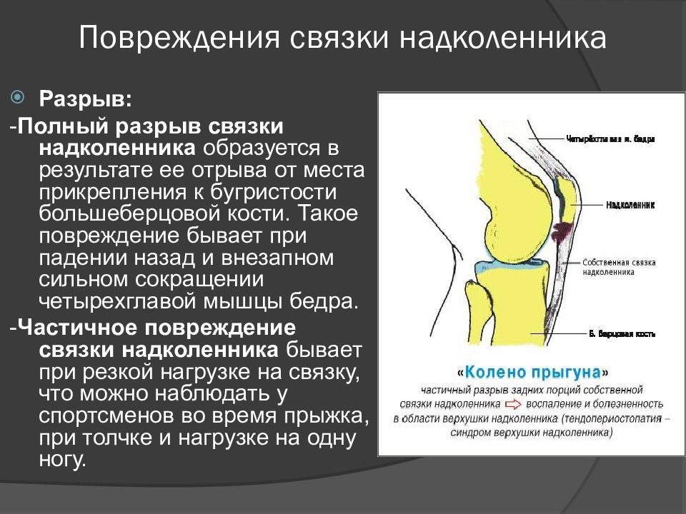 Повреждение коленного сустава презентация