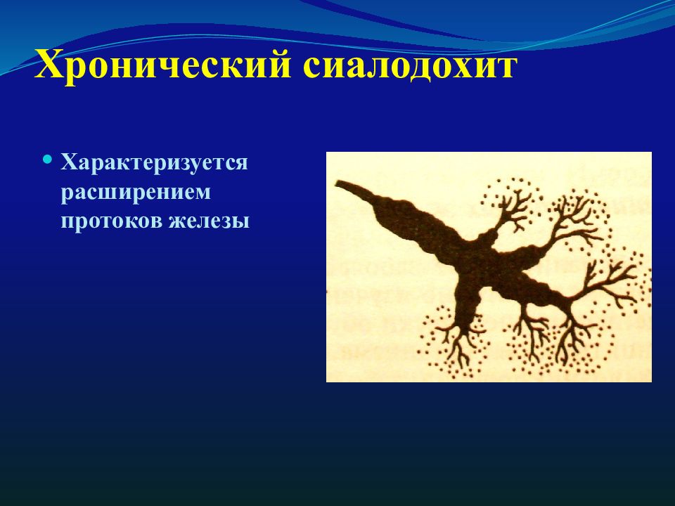 Расширение протоков. Хронический сиалодохит. Хронический интерстициальный сиалодохит. Сиалодохит презентация.