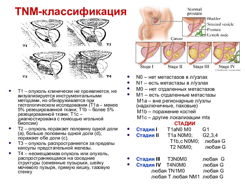 Рак предстательной железы презентация по урологии