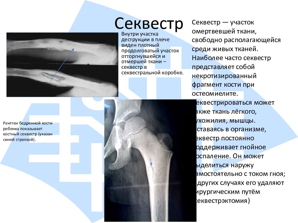 Кости причина. Секвестр ребра на рентгене. Секвестр костной ткани рентген. Деструкция кости на рентгене. Костный секвестр рентгенологически характеризуется.