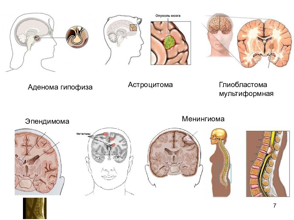 Опухоли цнс презентация