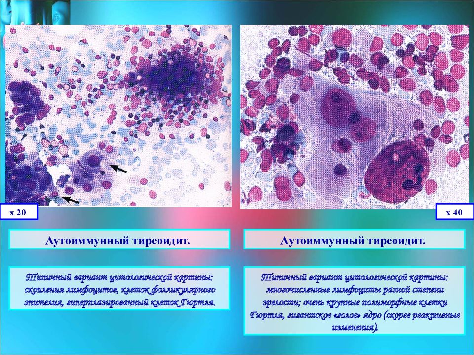 Часть клеток с реактивными изменениями. Аутоиммунный тиреоидит. Аутоиммунный тиреоидит клиника. Цитологическая картина воспалительного процесса.
