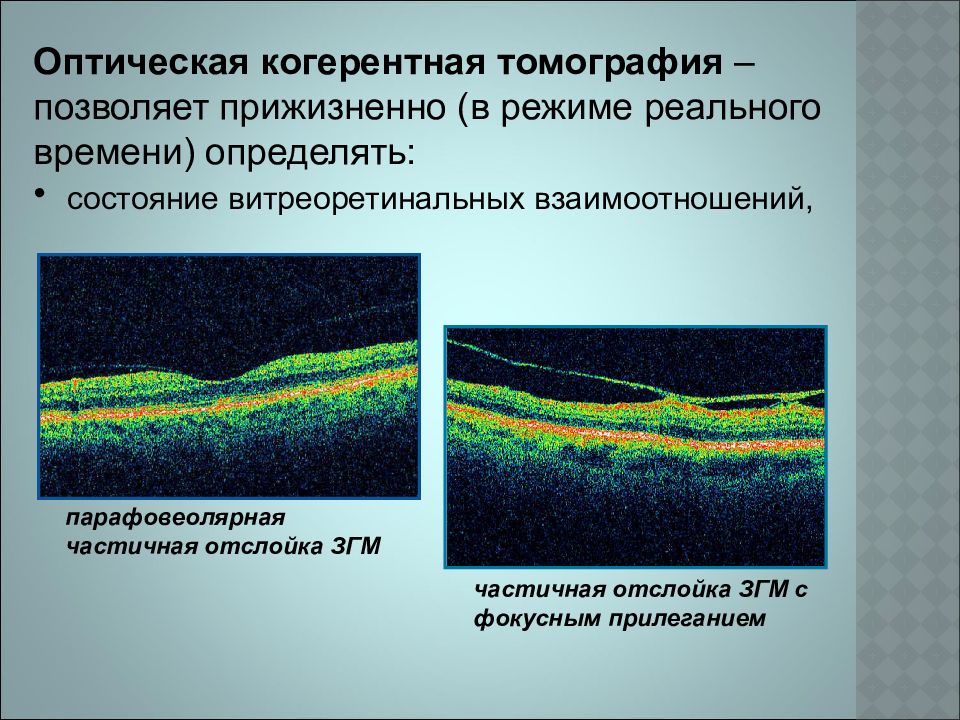 Когерентное пространство времен. Оптическая когерентная томография норма. Оптическая когерентная томография макулярной области. Снимки оптической когерентной томографии. Отслойка задней гиалоидной.