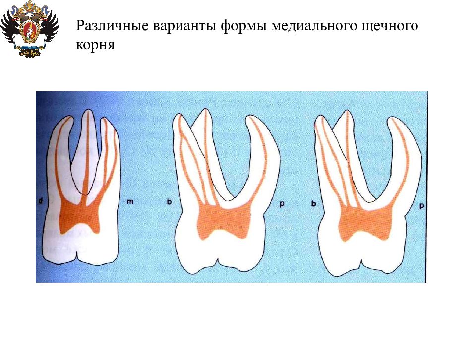 Анатомия каналов. Медиально щечный корень зуба. Медиальный корневой канал. Медиально щечный канал. Медиальный щечный корень.