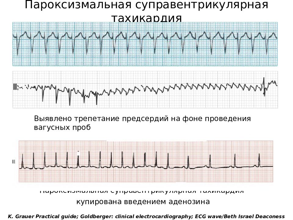 Пароксизмальная тахикардия на экг. ЭКГ при пароксизмальной тахикардии предсердий. Суправентрикулярная тахикардия (свт) ЭКГ. ЭКГ при пароксизмальной наджелудочковой тахикардии. ЭКГ при пароксизмальной суправентрикулярной тахикардии.