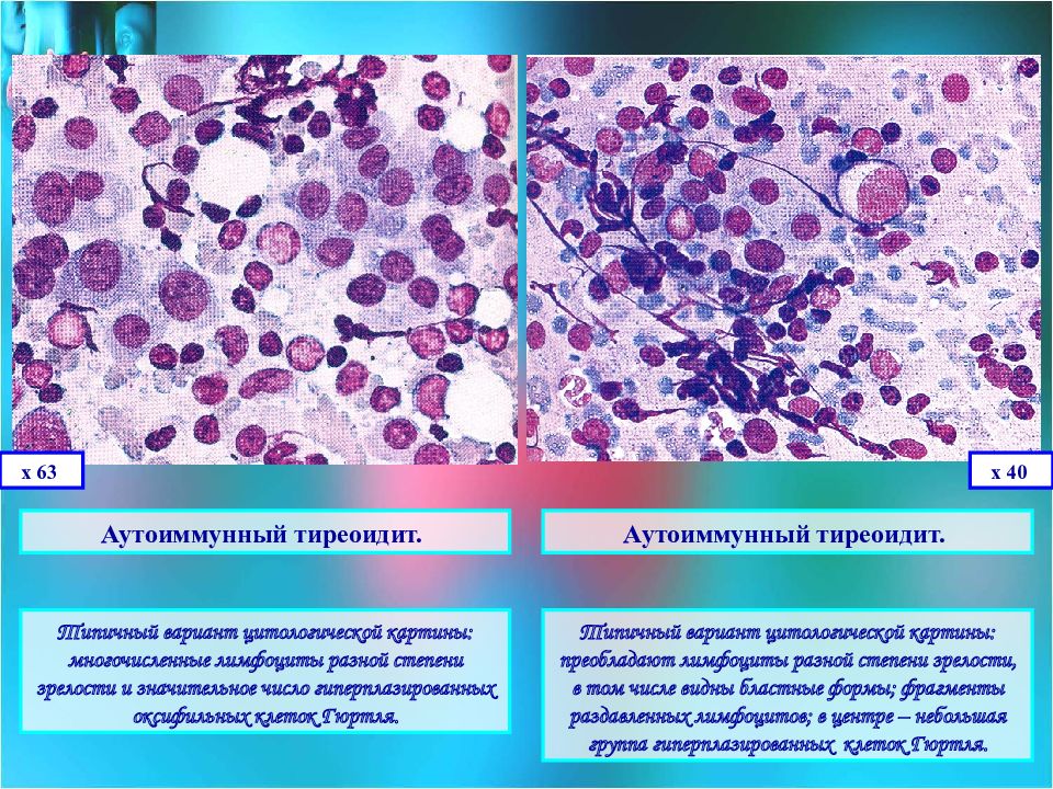 Цитологическая картина тиреоидита хашимото