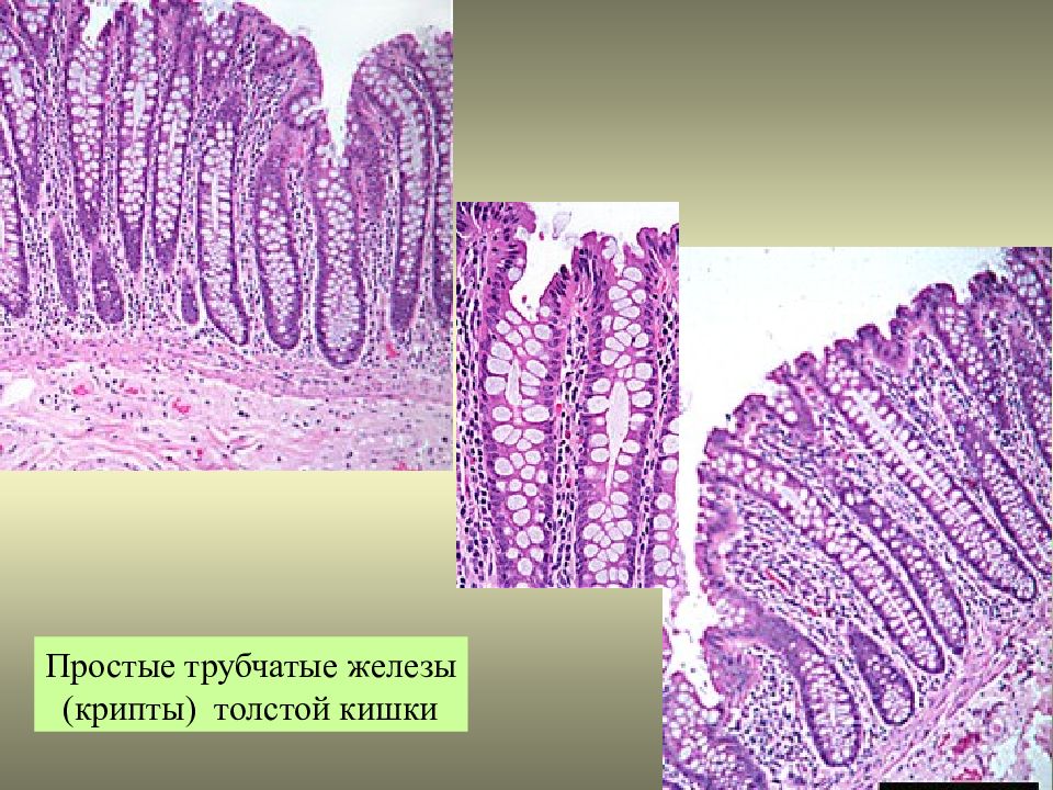 Простые трубчатые. Железы толстой кишки гистология. Крипты толстой кишки гистология. Эпителий крипт Толстого кишечника. Тубуло-ворсинчатая аденома толстой кишки гистология.
