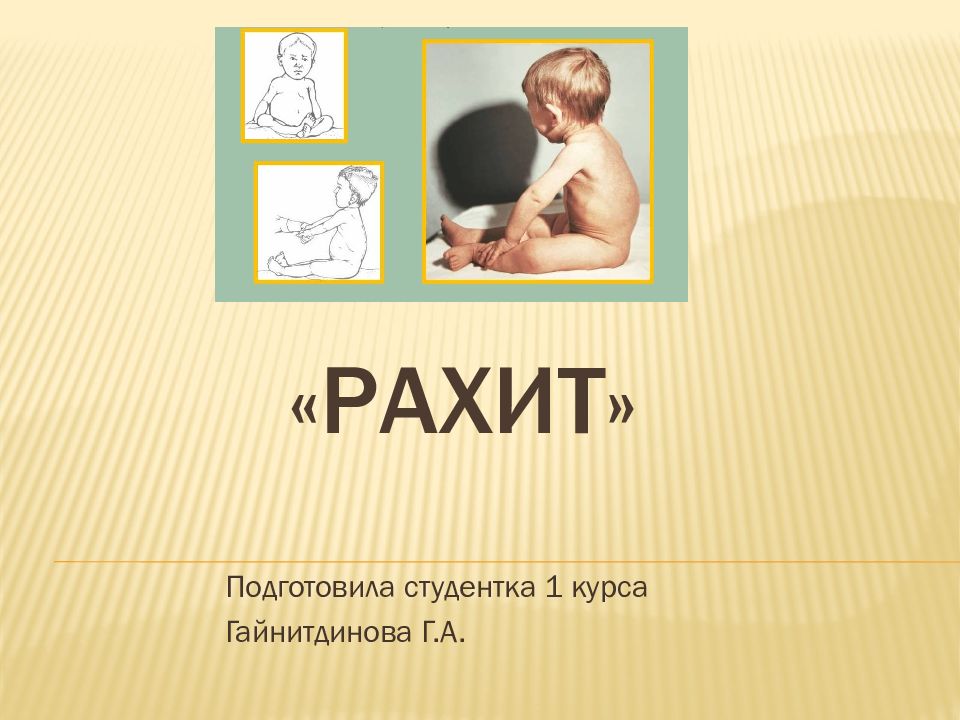 «Рахит»