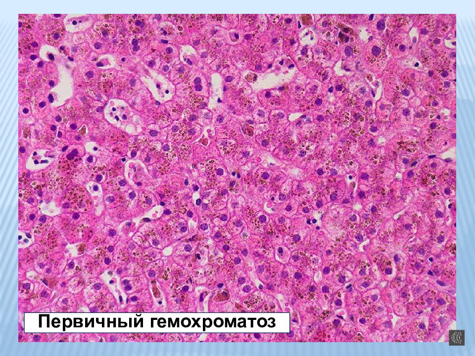 Презентация смешанные дистрофии