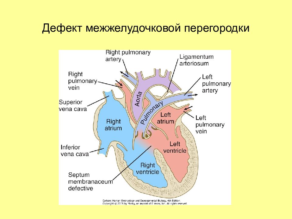 Межжелудочковая перегородка. Части межжелудочковой перегородки. Меж желудочное перегородка. Дефект межжелудочковой перегородки схема.