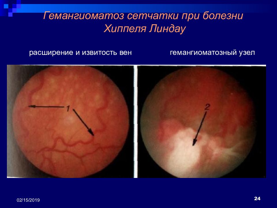 Синдром фон хиппеля линдау