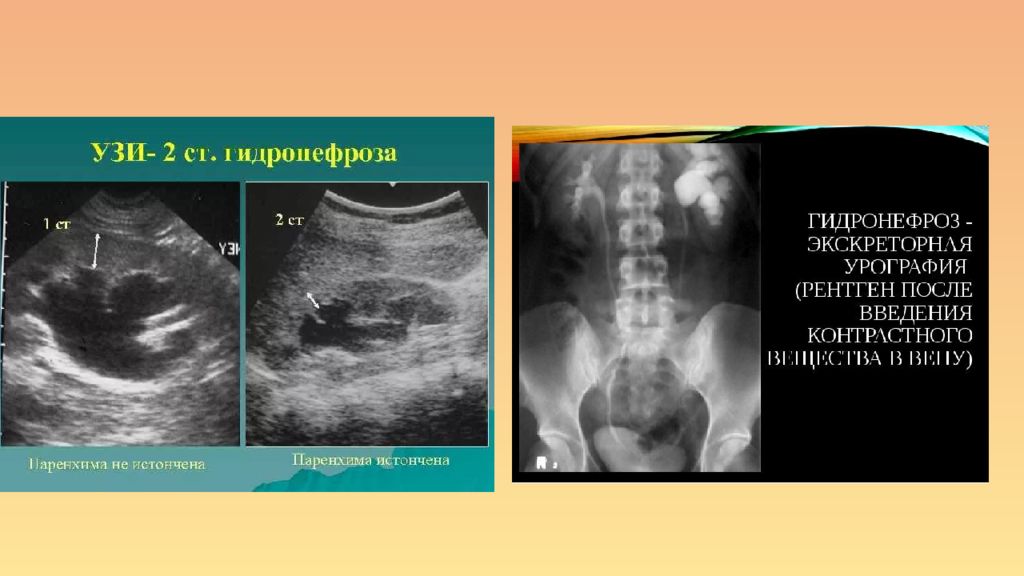 Что такое гидронефроз почки у взрослых. Гидронефроз почки УЗИ. Нефроптоз УЗИ признаки.