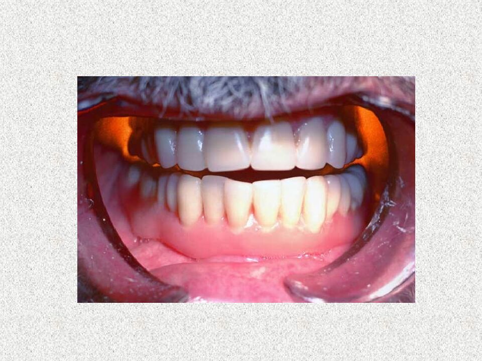 Funksional otisklar uchun individual qoshiqchalar