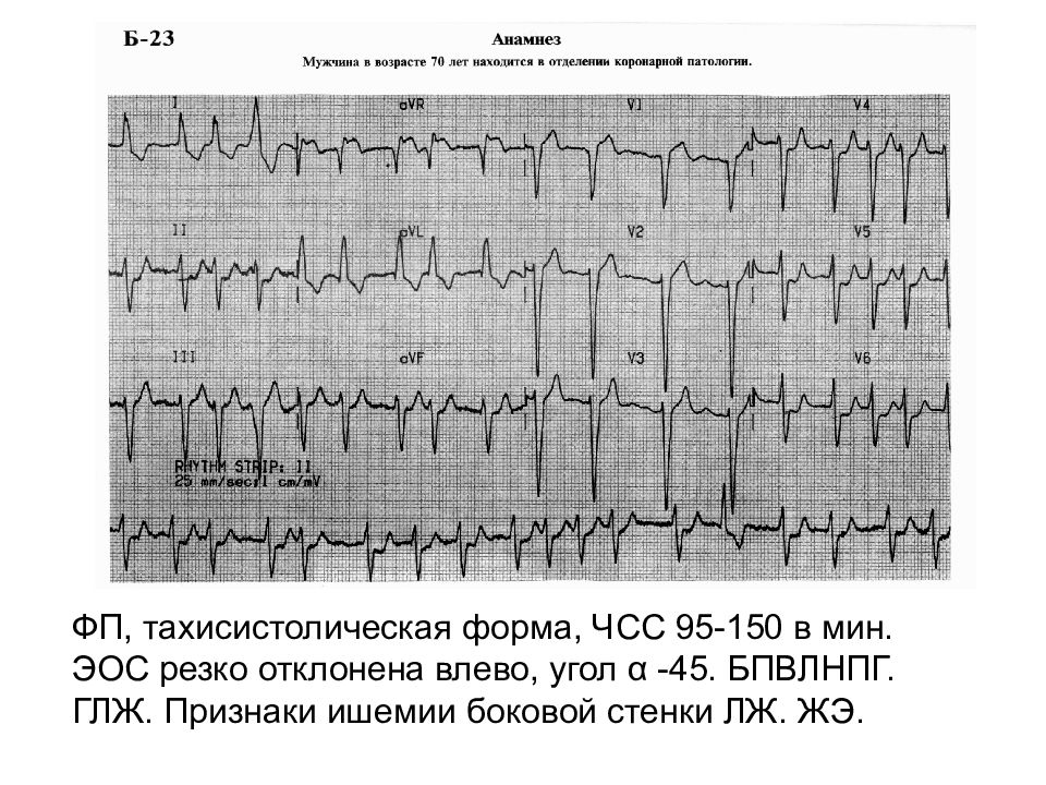 Экг резкое отклонение влево