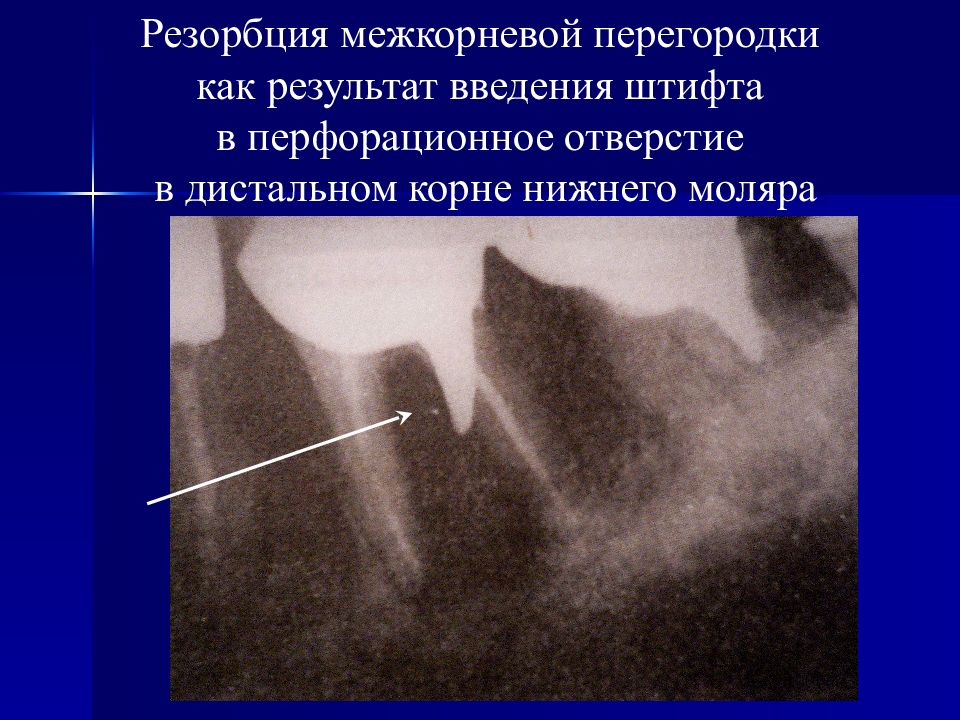 Удаление перегородки зуба