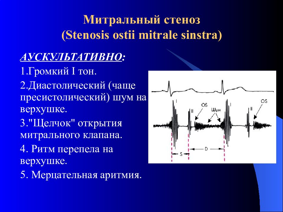 Аускультативная картина при митральном стенозе сердца включает на верхушке