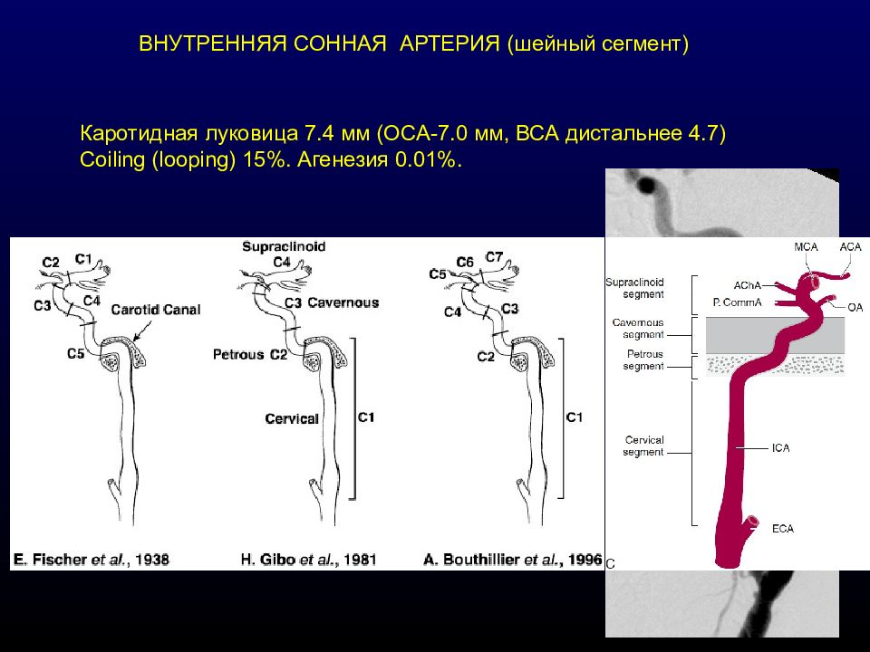 Сегменты внутренней сонной артерии схема