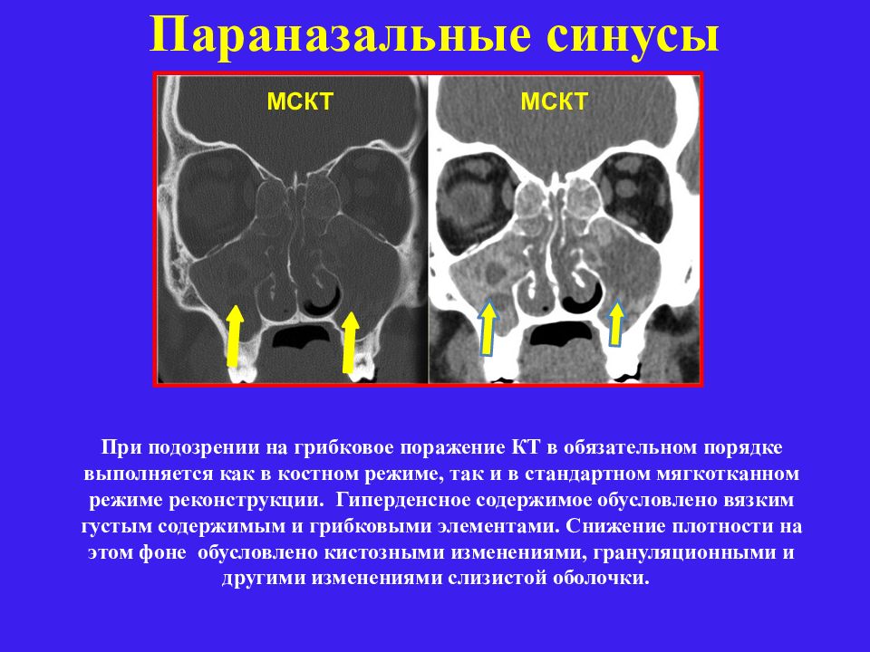 Что означает кт. Грибковое поражение пазух носа на кт. Мицетома гайморовой пазухи на кт.