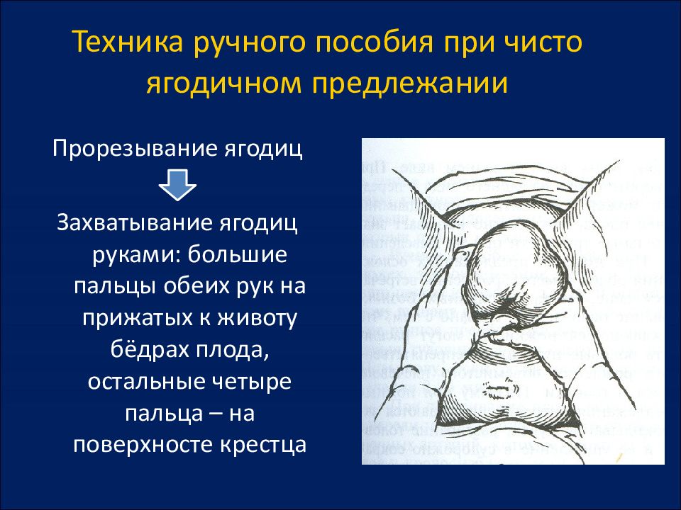 Ручное пособие по цовьянову. Ручное пособие по Цовьянову при тазовом предлежании. Пособие по Цовьянову при ягодичном предлежании. Ручное пособие по Цовьянову при чисто ягодичном предлежании. Пособие при ножном предлежании.