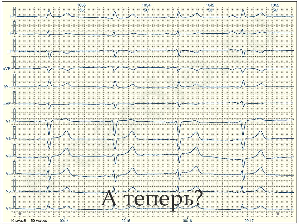 Экг презентация