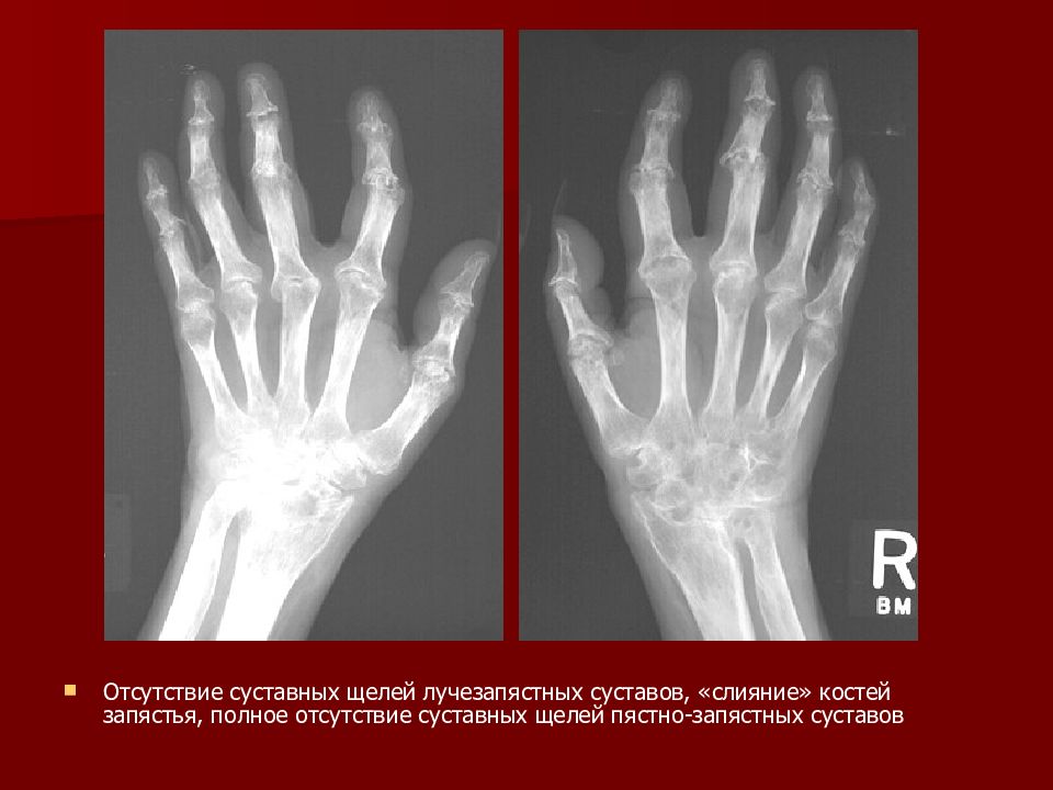 дисторсия лучезапястного сустава. артрозо-артрит лучезапястного сустава. ревматоидный артрит 1 степени рентген. ревматоидный артрит лучезапястного. стенозирующий тендовагинит.