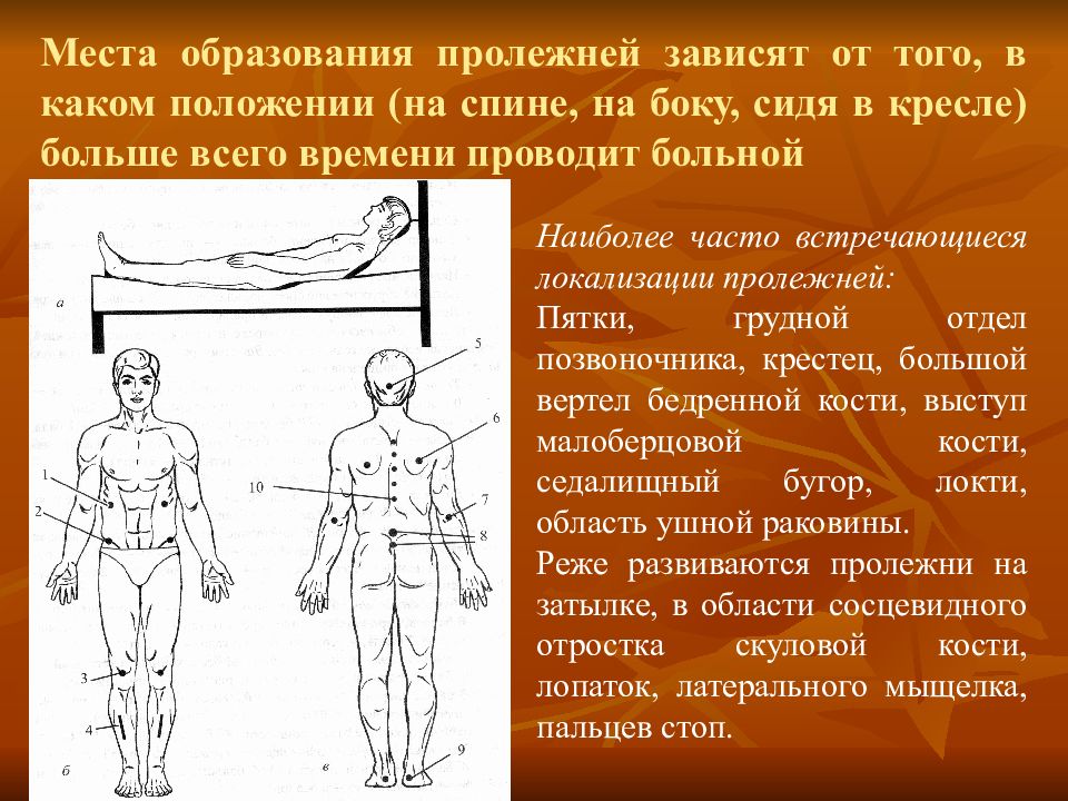 Места пролежней. Места образования пролежней. Места наиболее частого образования пролежней. Места возникновения пролежней. Места образования пролежней на спине.