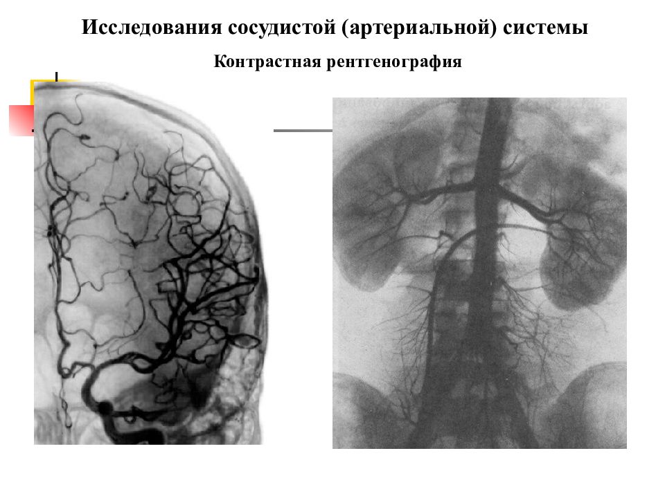 Локальный гипертонус задней стенки