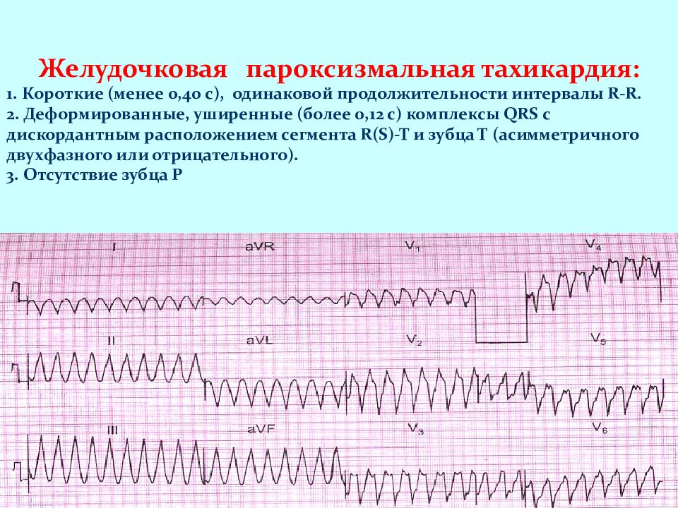 Экг при нарушениях ритма и проводимости презентация