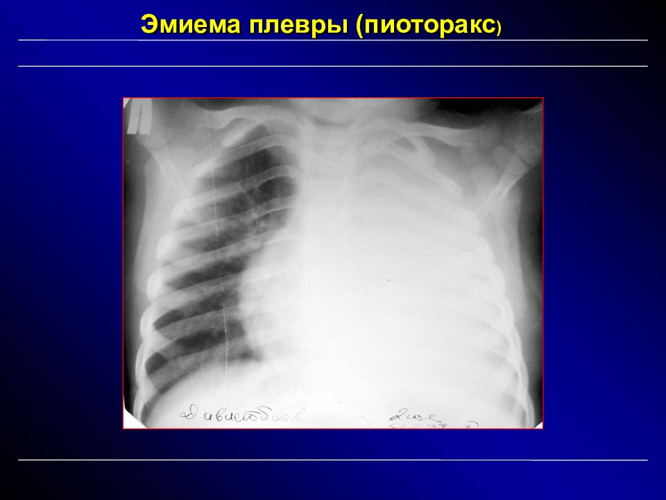 Пиоторакс это. Пиоторакс рентгенограмма. Пиоторакс при пневмонии.