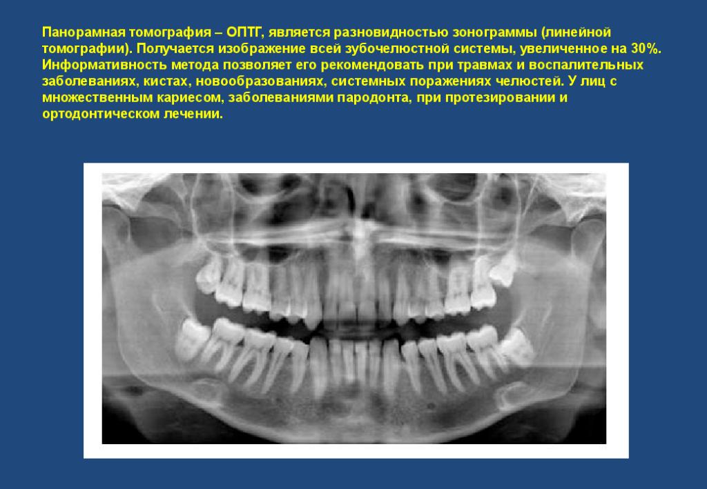 Вариант зонографии позволяющий получить развернутое плоскостное изображение челюстей