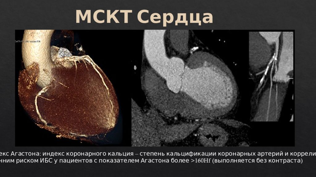 Исследование коронарного кальция. Кальциноз коронарных сосудов кт. Мультиспиральная кт сердца и коронарных артерий. Кальциноз коронарных артерий на кт. Кт оценка коронарного кальция.