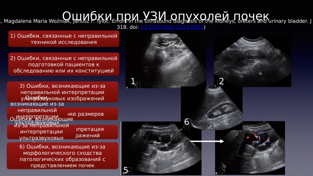 Как выглядят опухоли на узи