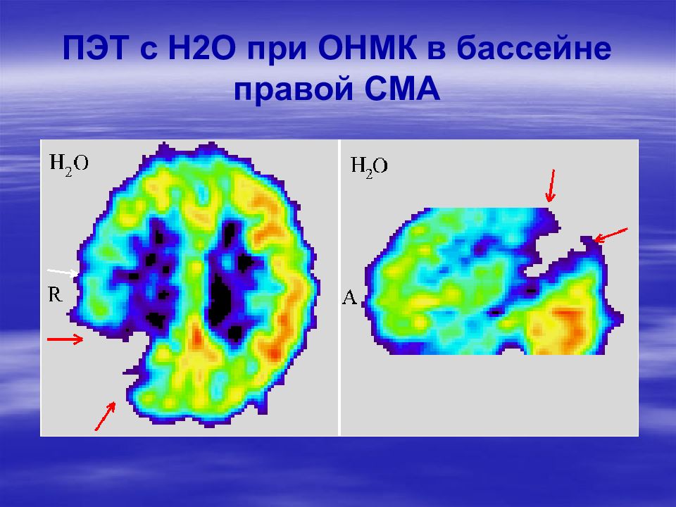 Онмк в бассейне сма. Бассейн правой сма. бассейн правой средней мозговой артерии. последствия онмк в бассейне правой сма.