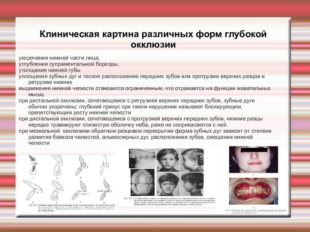 Классификация клиническая картина. Супраментальная складка на лице это. Клиническая картина различных форм дистальной окклюзии. Уплощение нижней челюсти.