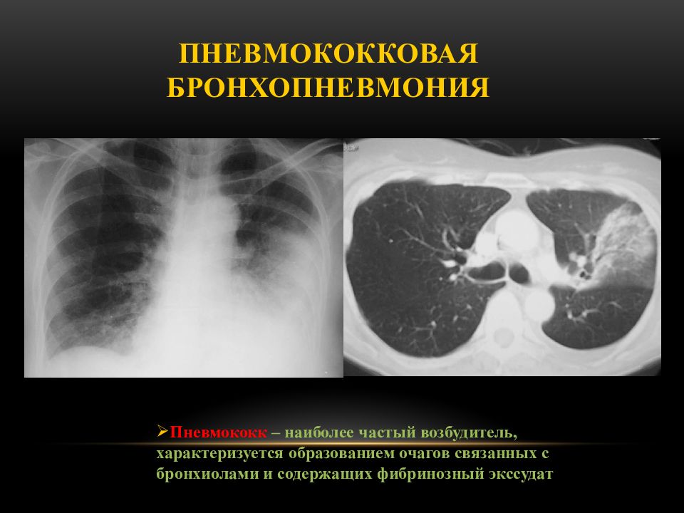 Бронхопневмония. Осложнения бронхопневмонии. Пневмококковая бронхопневмония. Бронхопневмония вызванная пневмококками.