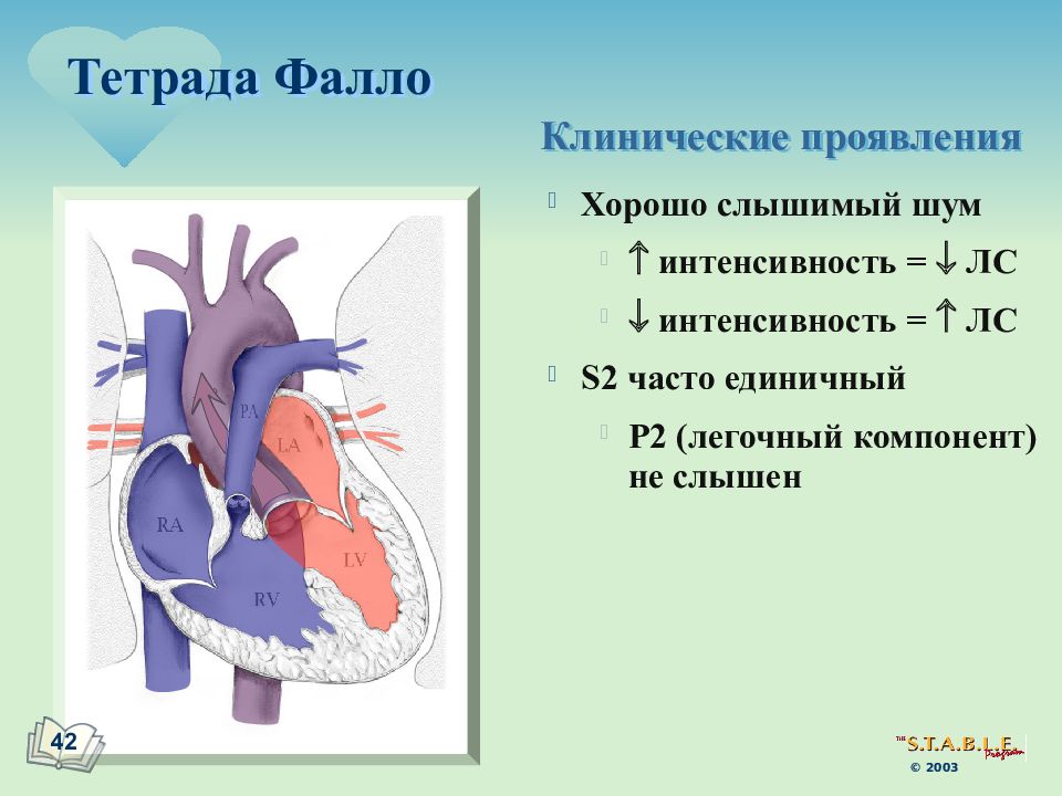 Тетрада фалло лечение