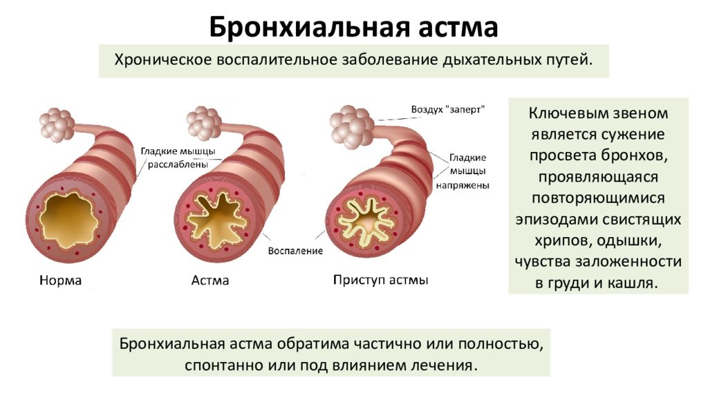 Бронхит у человека. Обструкция дыхательных путей бронхиальная астма. Бронхиальная обструкция при бронхиальной астме. Изменение бронхов при бронхиальной астме. Обструкция дыхательных путей при бронхиальной астме.