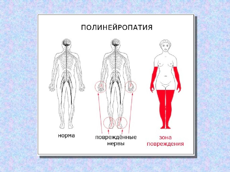 Что такое периферическая нейропатия. Линии Блашко и линии Лангера. Линии Лангера на теле человека. Линии Блашко на теле человека.