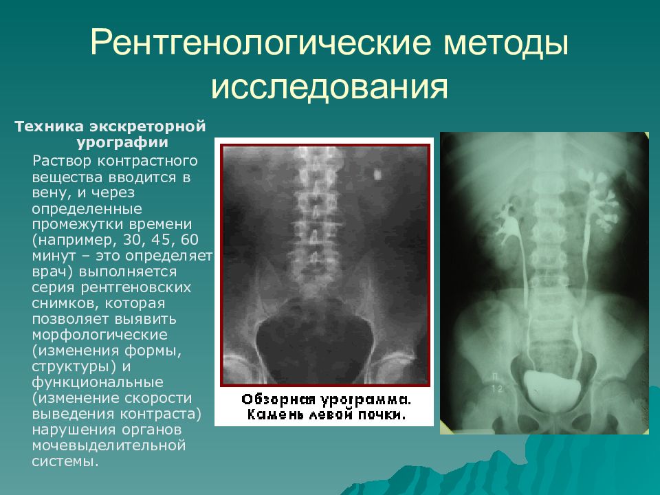 Внутривенная урография презентация