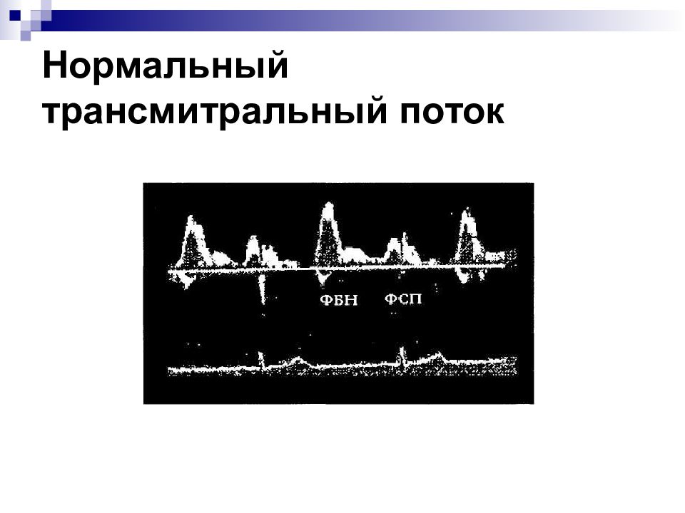 28 нормально. Трансмитральный поток. Однопиковый трансмитральный поток. Трансмитральный поток Изменен. 1 Тип патологического трансмитрального потока.